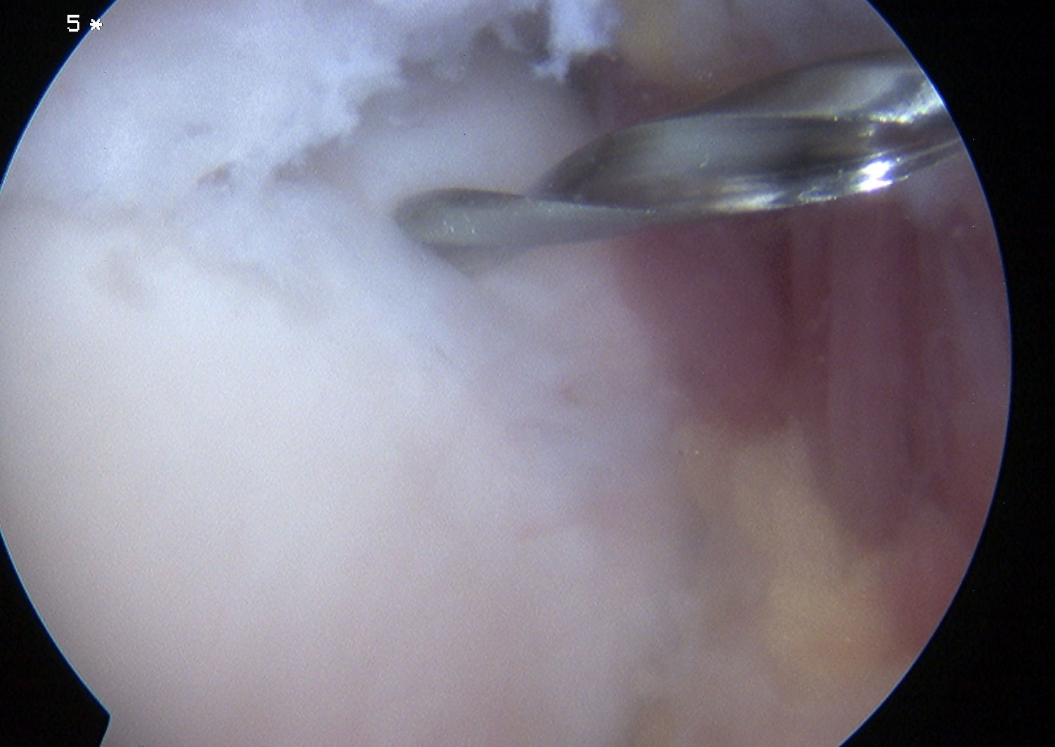 Ankle OCD Percutaneous Drilling 1